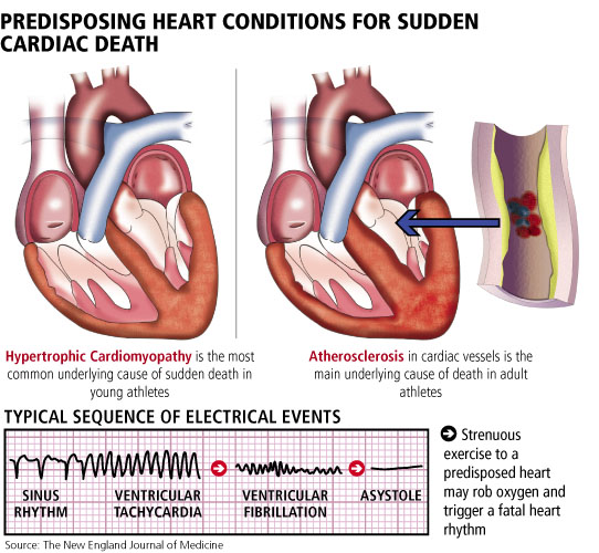 mg_12972_cardiac_death_big_280x210.jpg